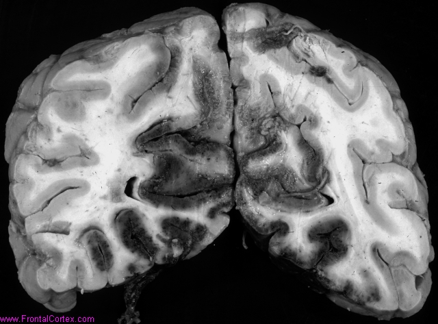 Hemorrhagic necrosis, posterior cerebral artery circulations, bilateral